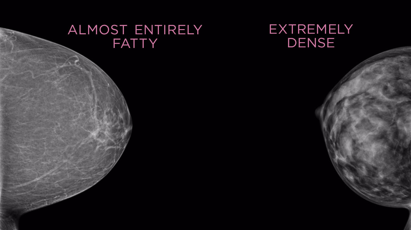 A 69-year-old woman with  non-dense  breast composition, small