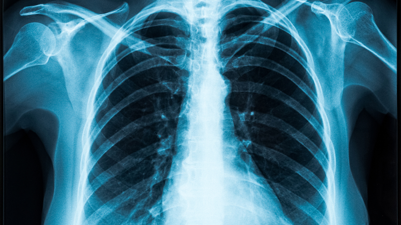 HOW DOES A CHEST X-RAY HELP DIAGNOSE BREATHING PROBLEMS? - Mayfair  Diagnostics