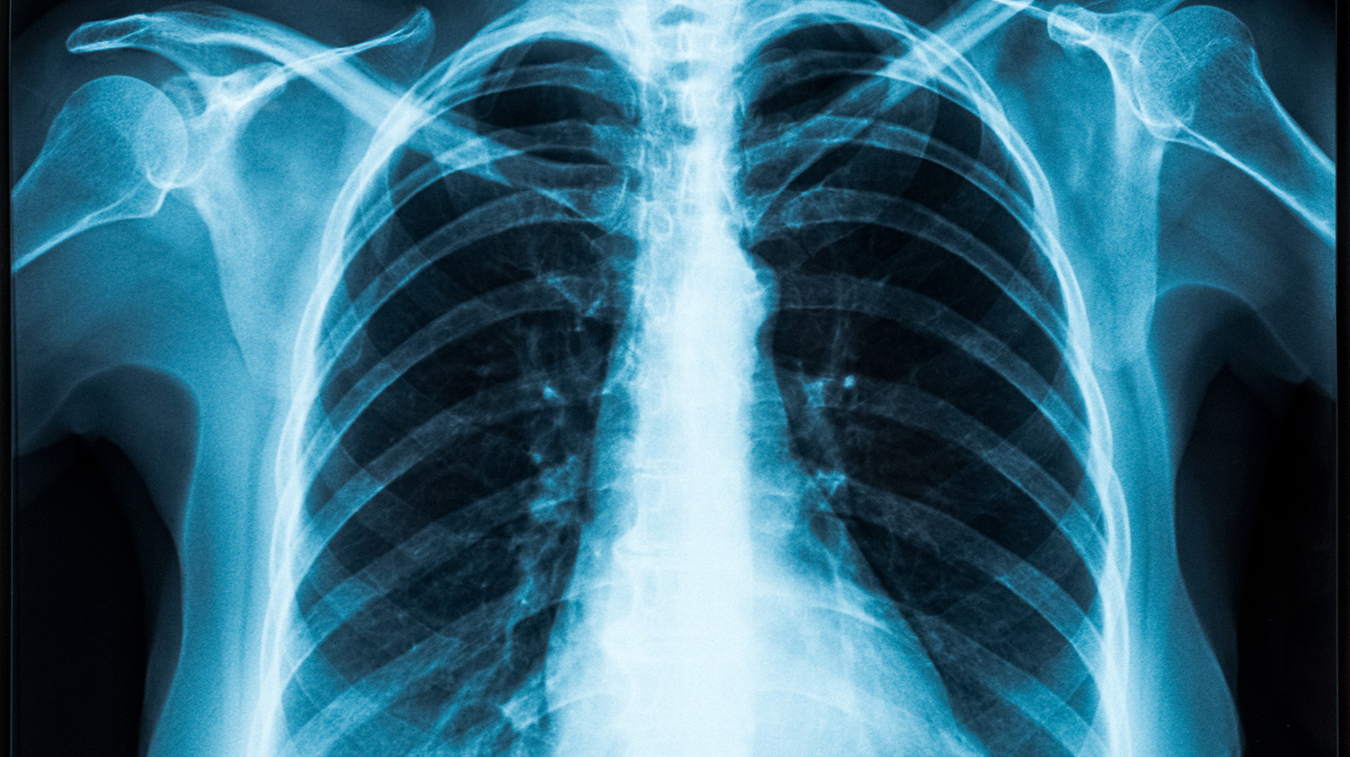 Respiratory Distress in a Patient with Clear Lungs: What You Need to Know