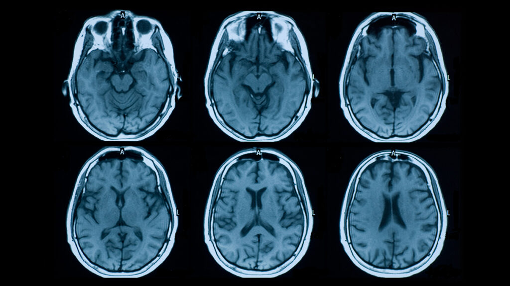 HOW DOES MRI HELP DIAGNOSE MS? Mayfair Diagnostics