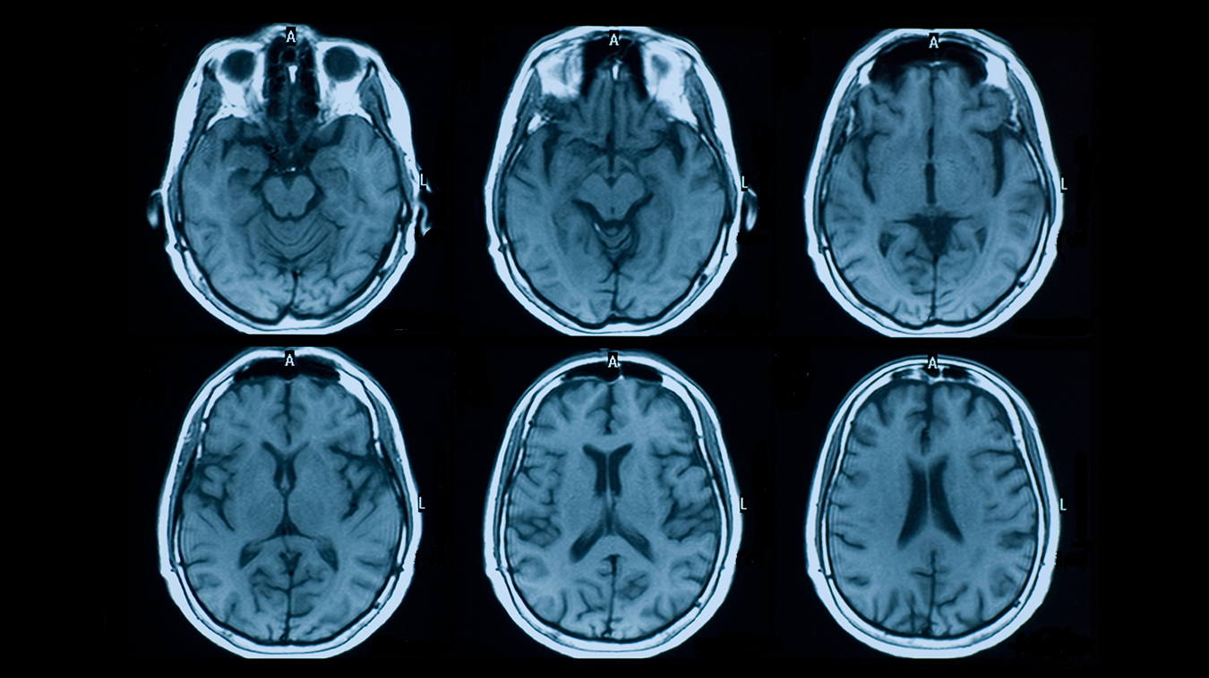 MRI Brain